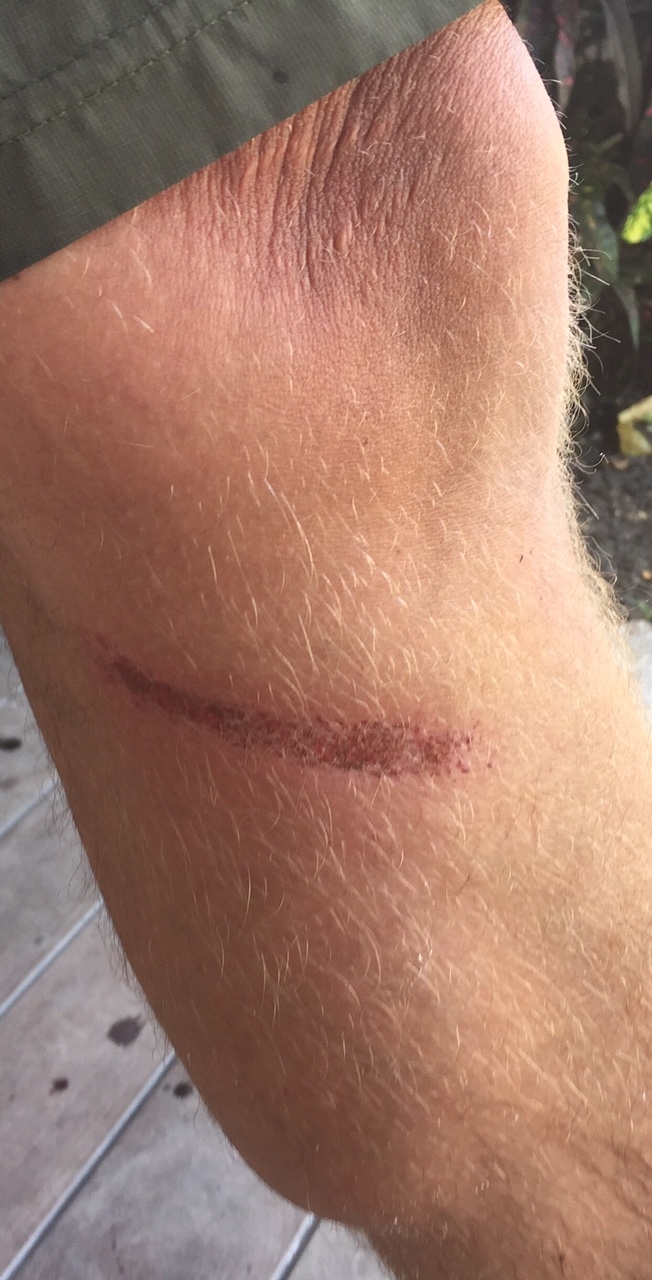 Rope burn injury due to sail handling