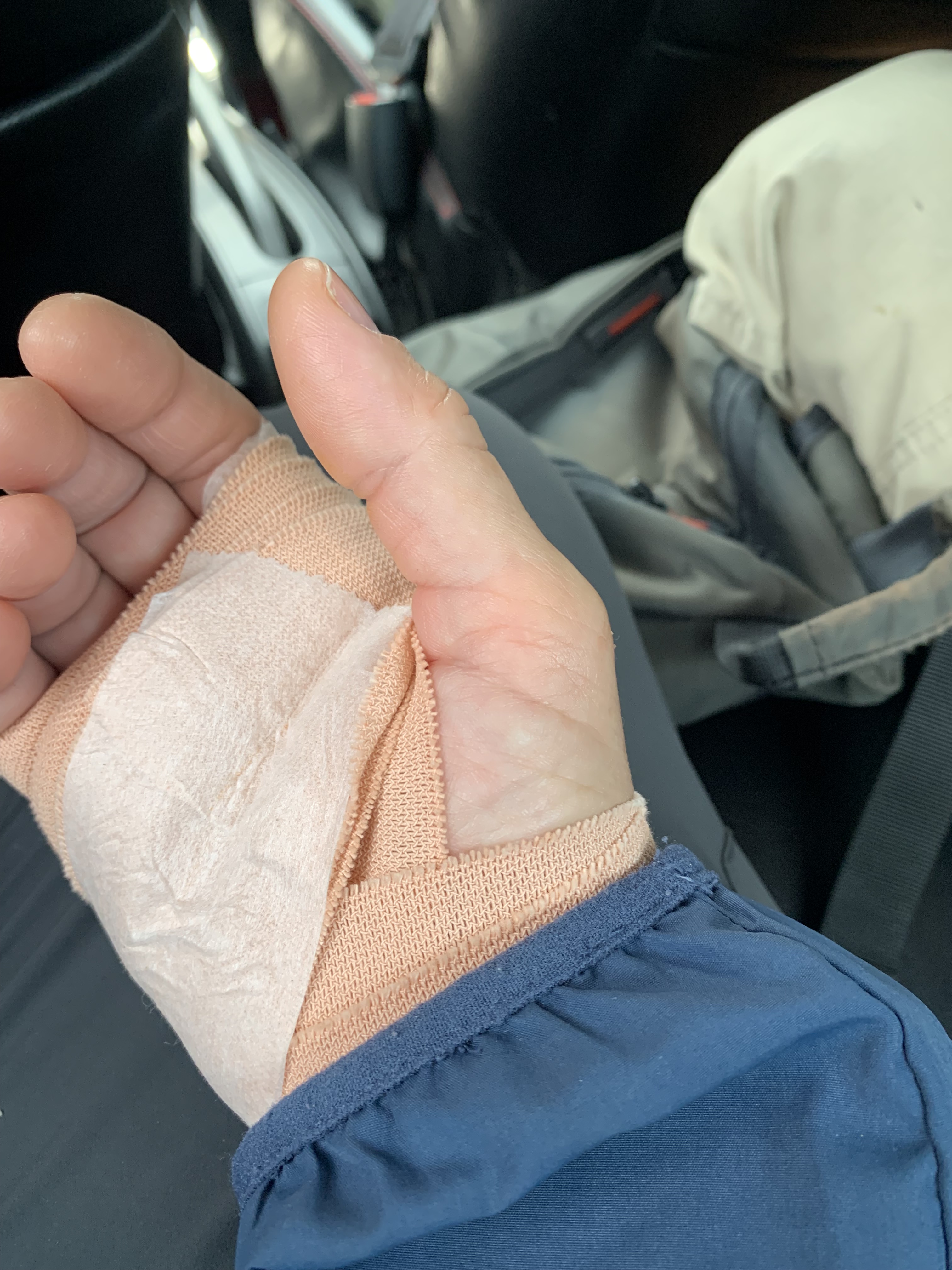 Bandaged hand folowig trigger release surgery at Assunta hospital.